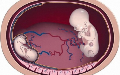 Nguy hiểm khôn lường từ hội chứng truyền máu song thai